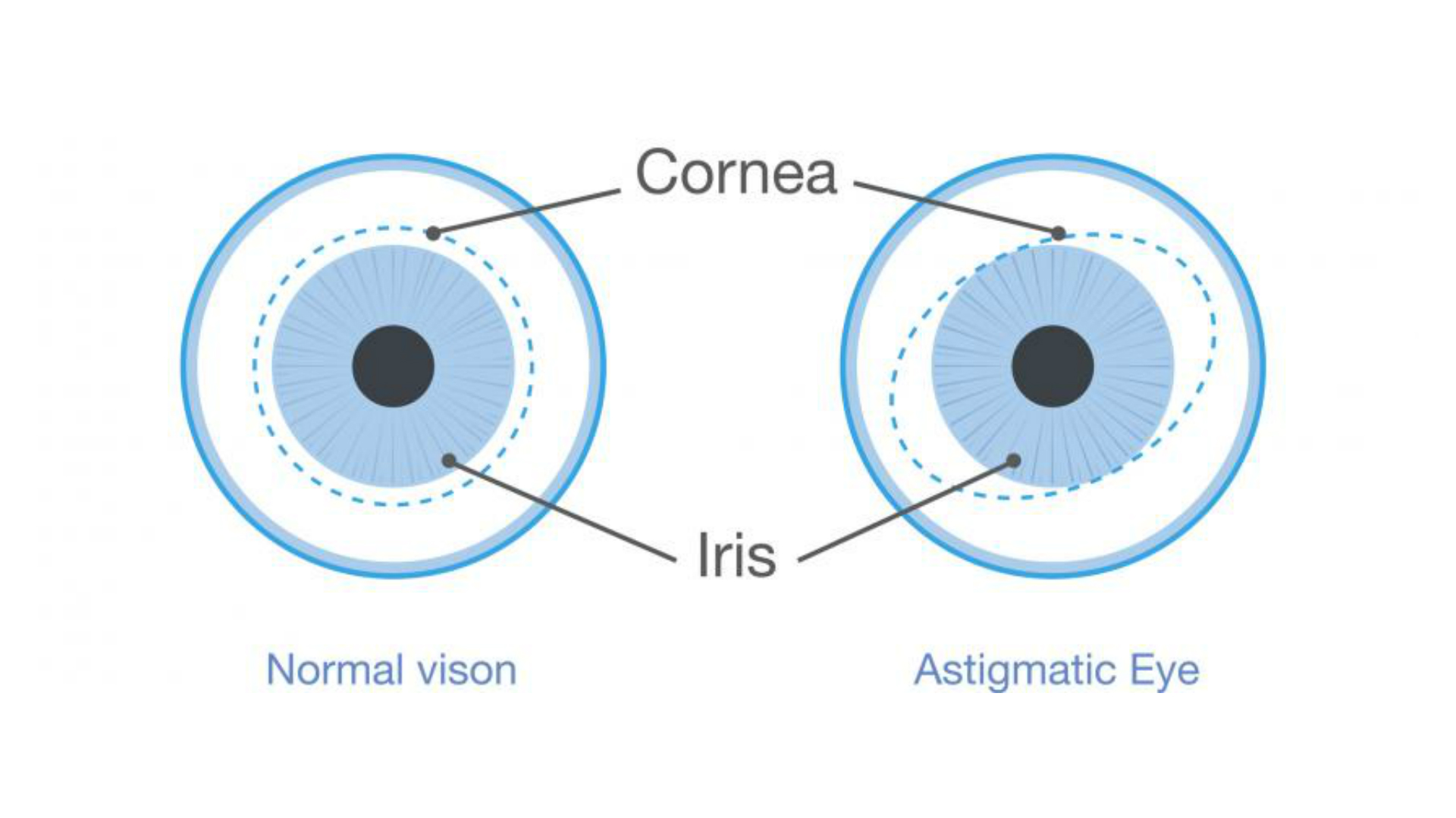散光图显示了正常和散光眼之间的差异